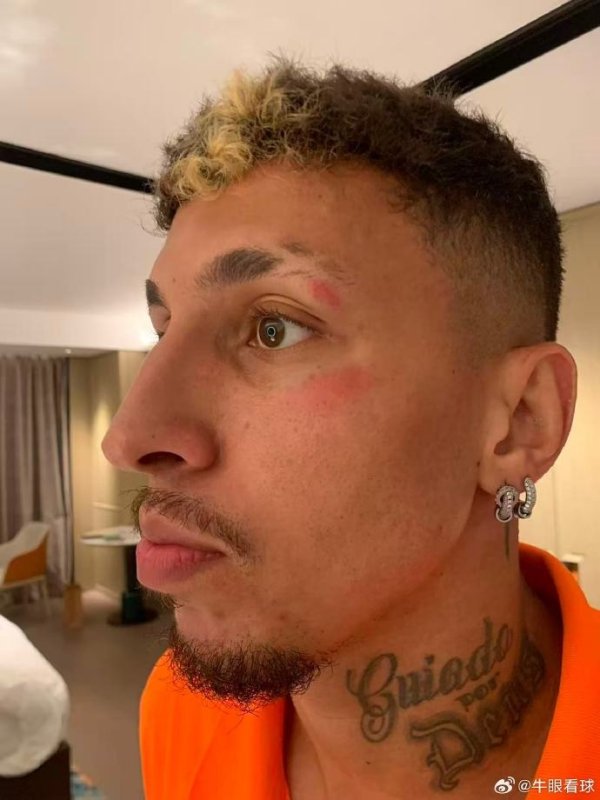 记者：克雷桑头部被踢了一下，换下他是用了脑震荡条款